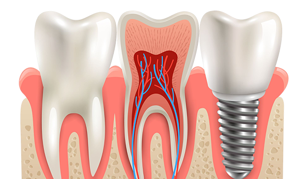 Implantes dentários